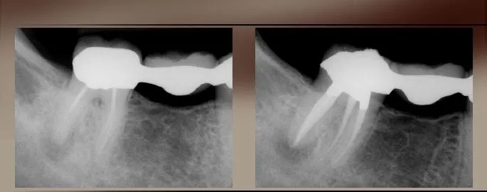 xrayretreatment