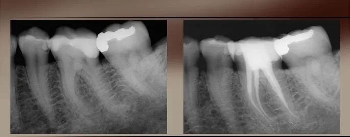xraytherapy